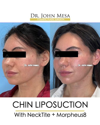 Chin Liposuction Before & After Gallery - Patient 148735136 - Image 4