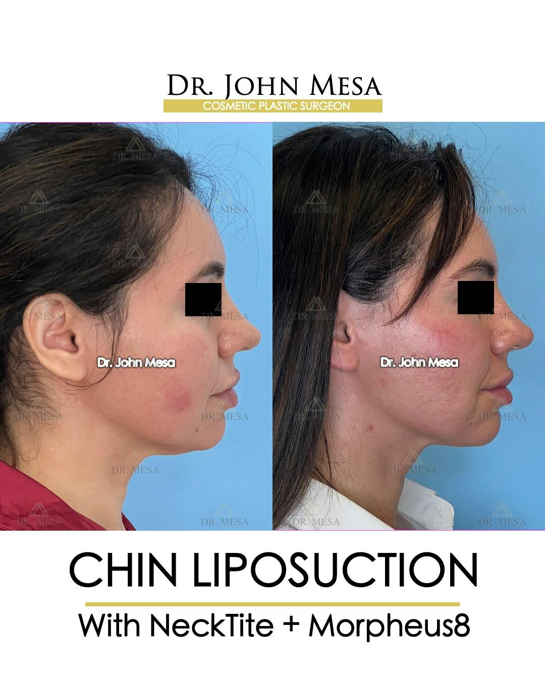 Chin Liposuction Before & After Gallery - Patient 148735136 - Image 1