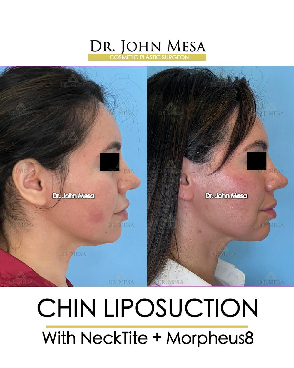 Chin Liposuction Before & After Gallery - Patient 148735136 - Image 4