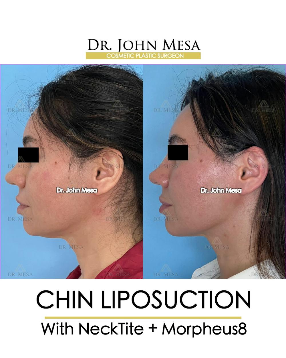 Chin Liposuction Before & After Gallery - Patient 148735136 - Image 5