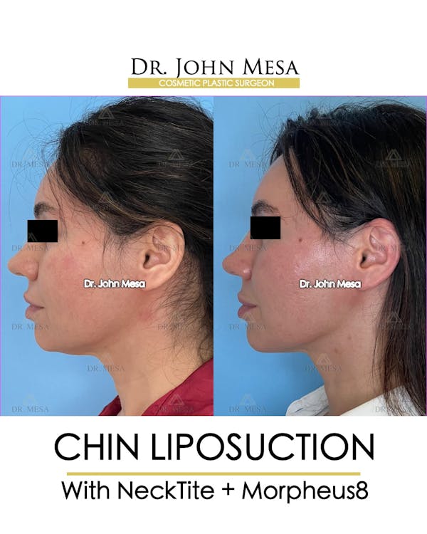 Chin Liposuction Before & After Gallery - Patient 148735136 - Image 5