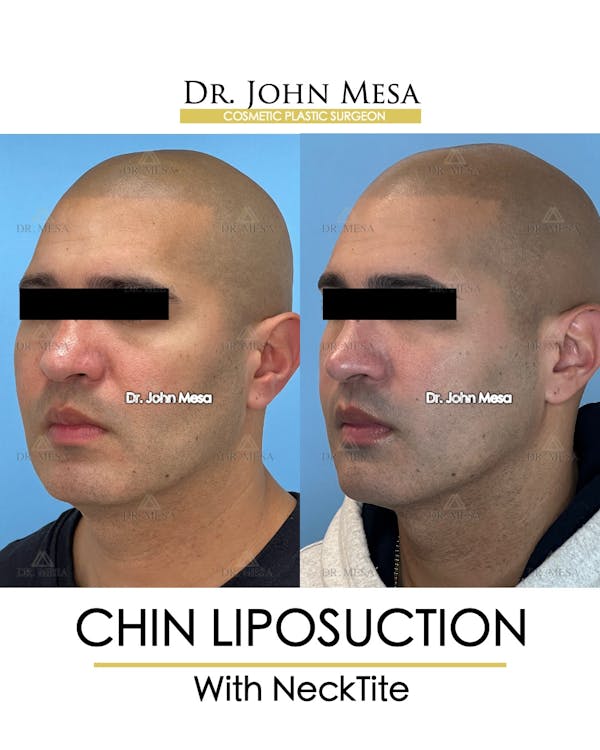 Chin Liposuction Before & After Gallery - Patient 148735274 - Image 4