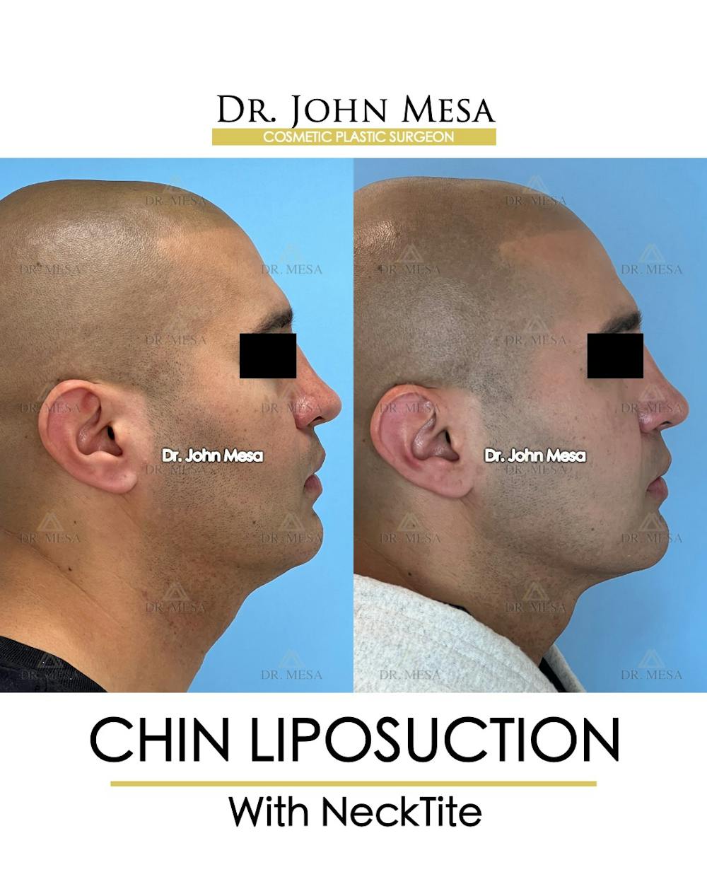 Chin Liposuction Before & After Gallery - Patient 148735274 - Image 3