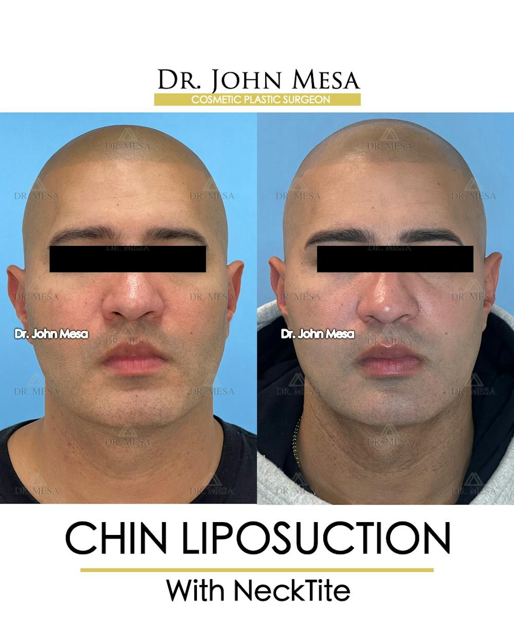 Chin Liposuction Before & After Gallery - Patient 148735274 - Image 2