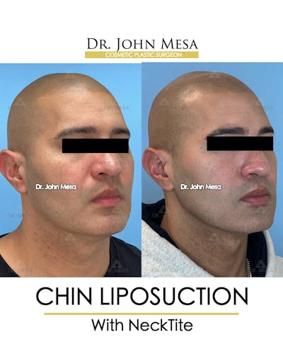 Chin Liposuction Before & After Gallery - Patient 148735274 - Image 2