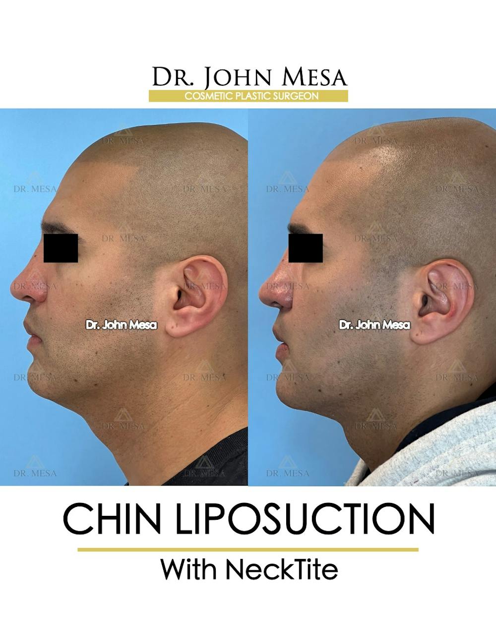 Chin Liposuction Before & After Gallery - Patient 148735274 - Image 5