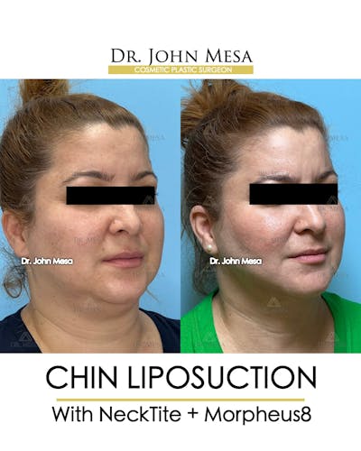 Chin Liposuction Before & After Gallery - Patient 148735138 - Image 2