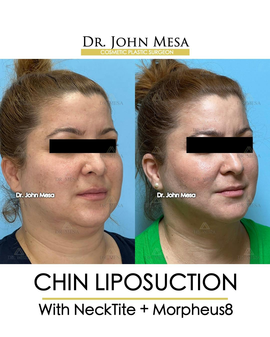 Chin Liposuction Before & After Gallery - Patient 148735138 - Image 2