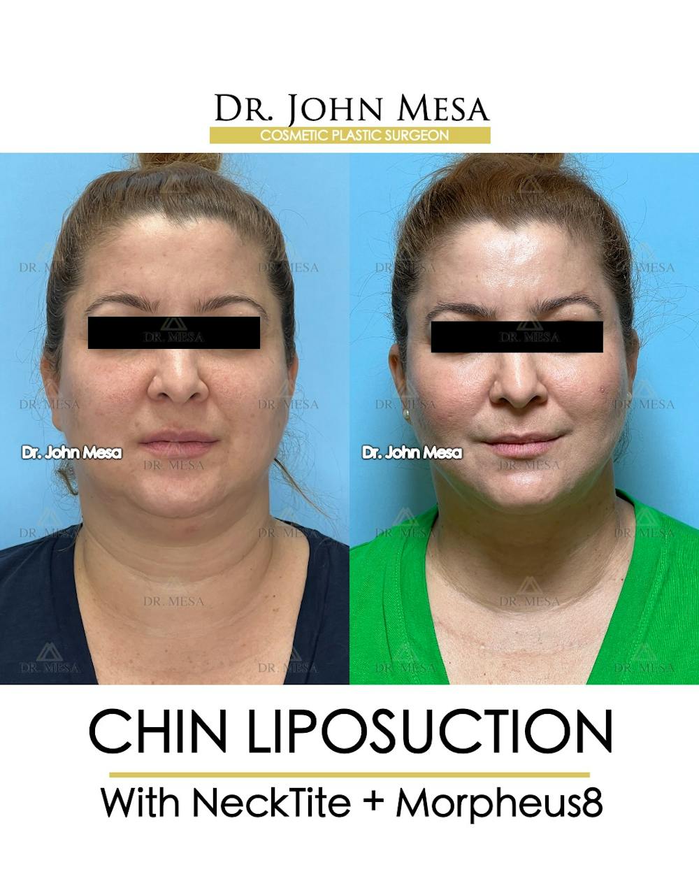 Chin Liposuction Before & After Gallery - Patient 148735138 - Image 1