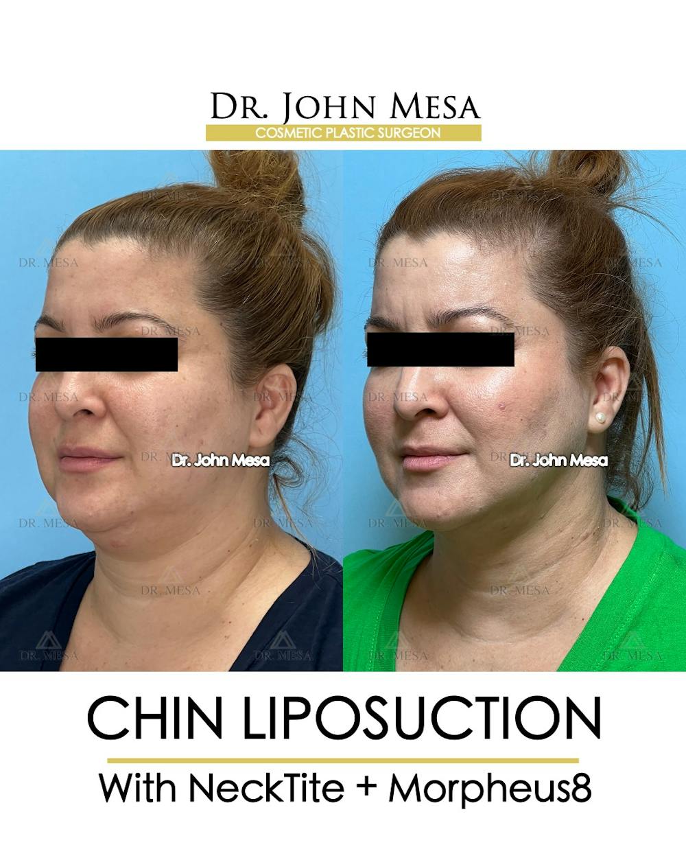 Chin Liposuction Before & After Gallery - Patient 148735138 - Image 4