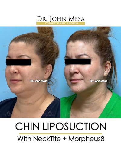 Chin Liposuction Before & After Gallery - Patient 148735138 - Image 4
