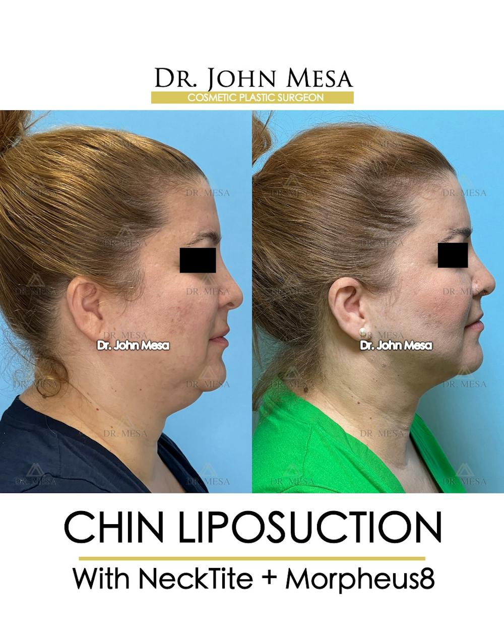 Chin Liposuction Before & After Gallery - Patient 148735138 - Image 3