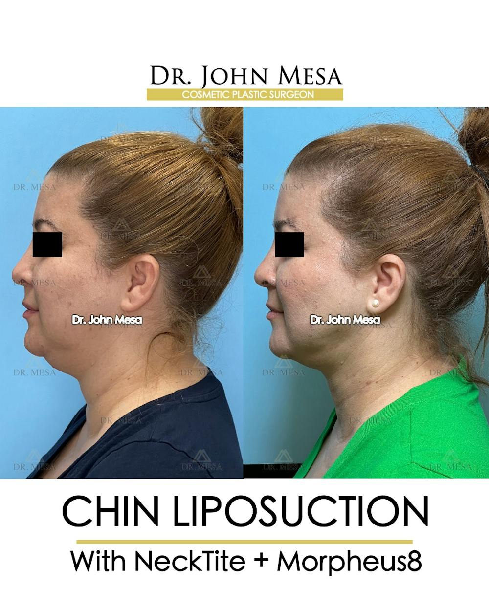 Chin Liposuction Before & After Gallery - Patient 148735138 - Image 5
