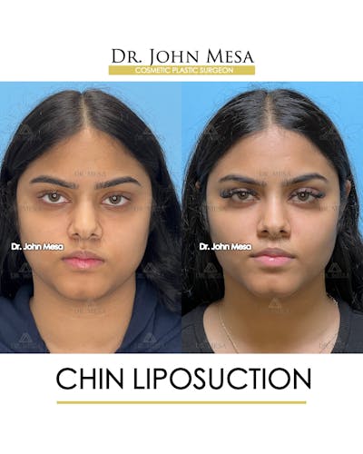 Chin Liposuction Before & After Gallery - Patient 148735139 - Image 1