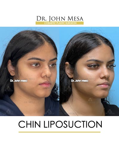 Chin Liposuction Before & After Gallery - Patient 148735139 - Image 2