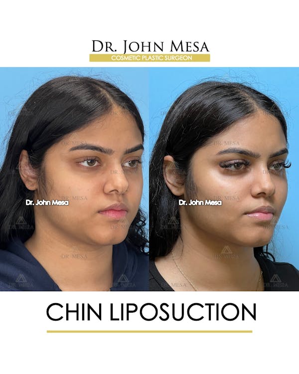 Chin Liposuction Before & After Gallery - Patient 148735139 - Image 2