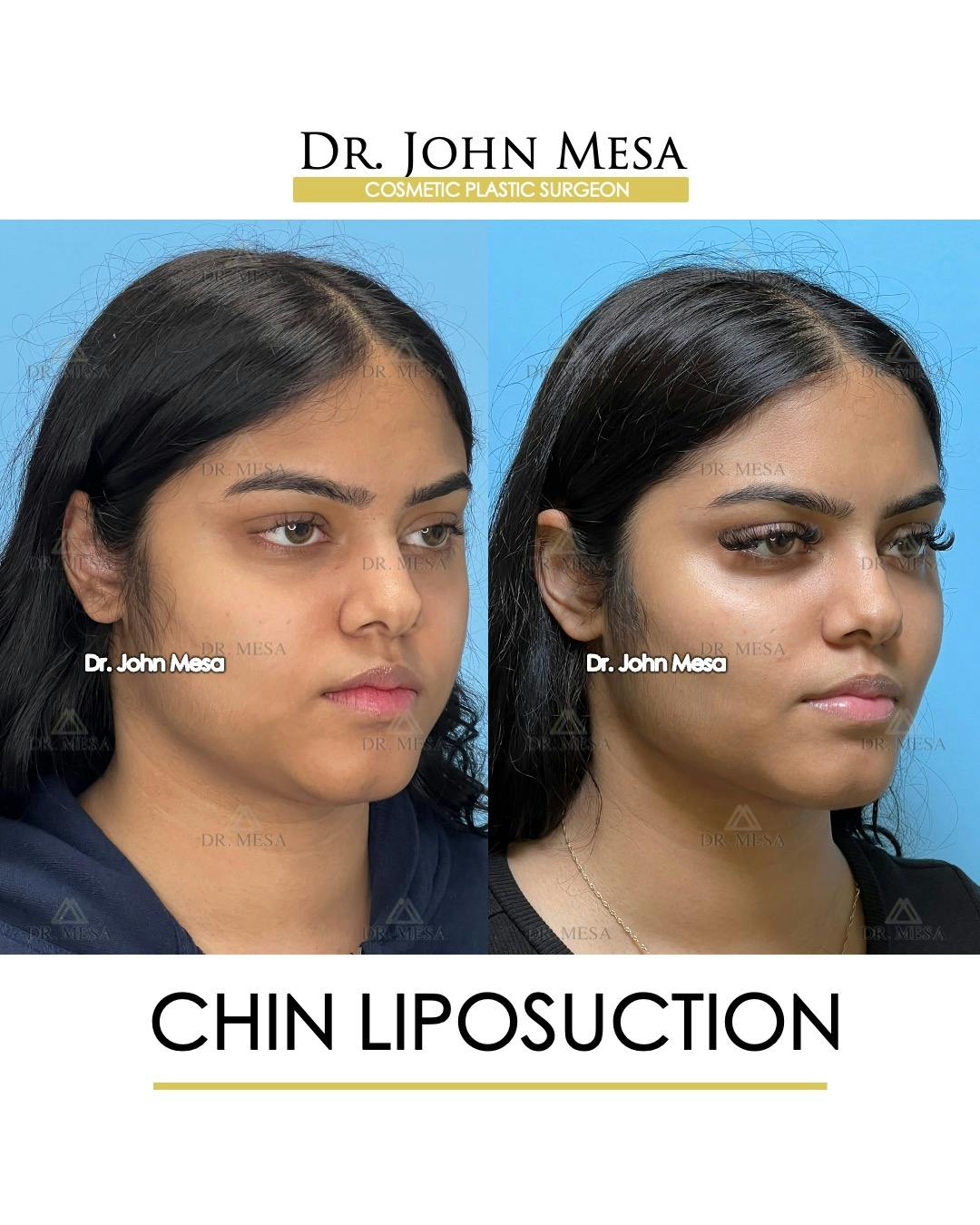 Chin Liposuction Before & After Gallery - Patient 148735139 - Image 2