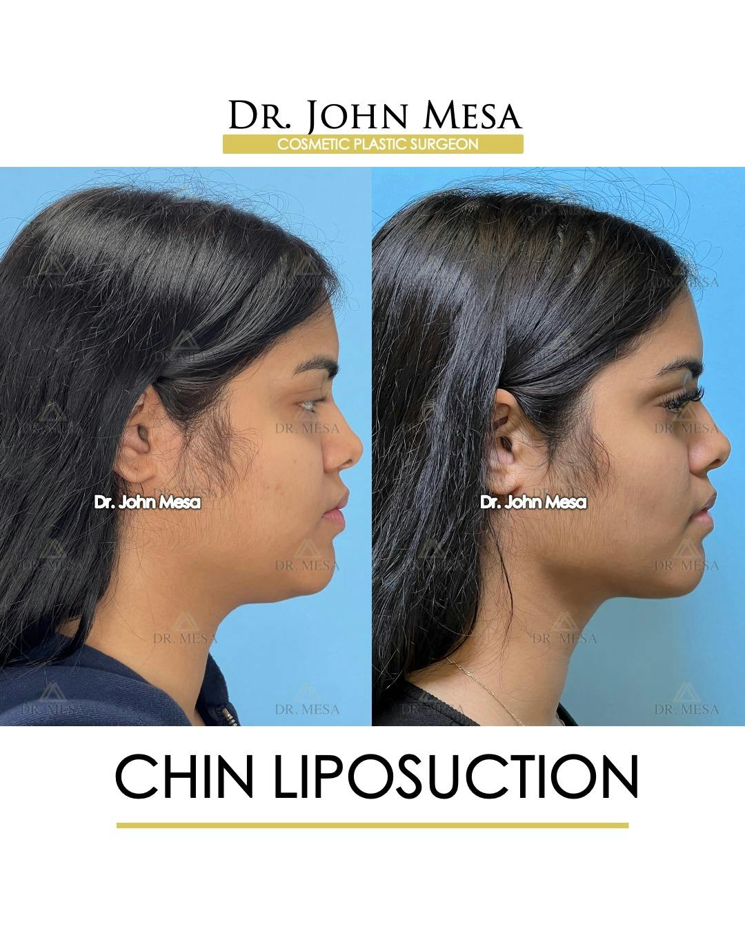 Chin Liposuction Before & After Gallery - Patient 148735139 - Image 1