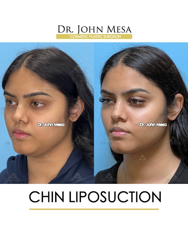 Chin Liposuction Before & After Gallery - Patient 148735139 - Image 4