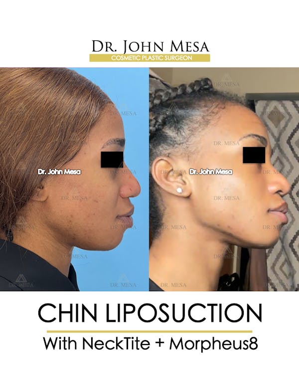 Chin Liposuction Before & After Gallery - Patient 148735140 - Image 3