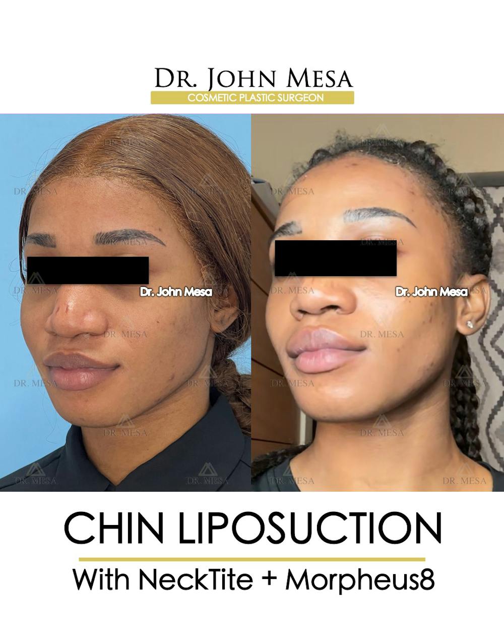 Chin Liposuction Before & After Gallery - Patient 148735140 - Image 4