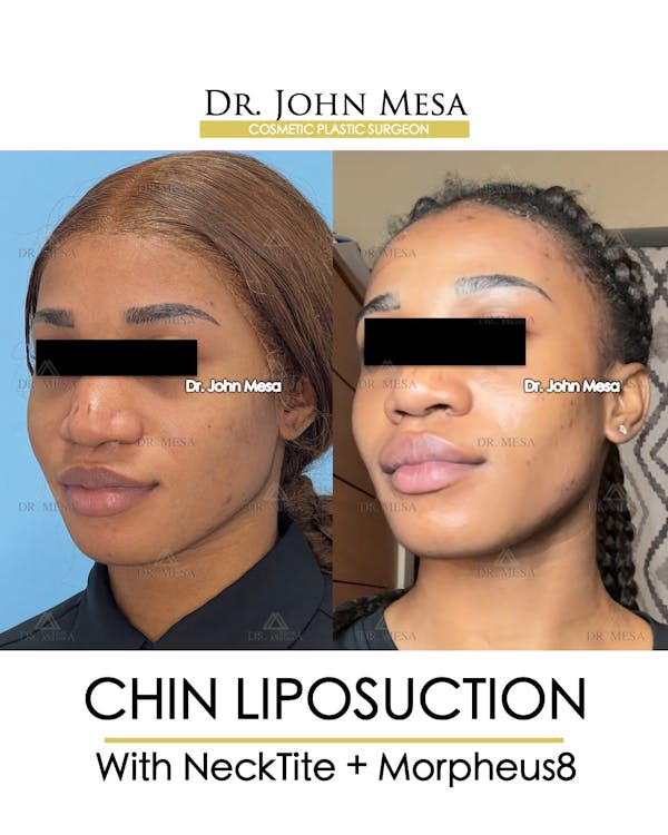 Chin Liposuction Before & After Gallery - Patient 148735140 - Image 4
