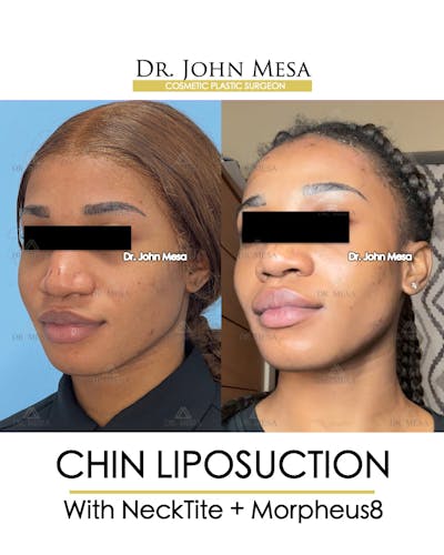 Chin Liposuction Before & After Gallery - Patient 148735140 - Image 4