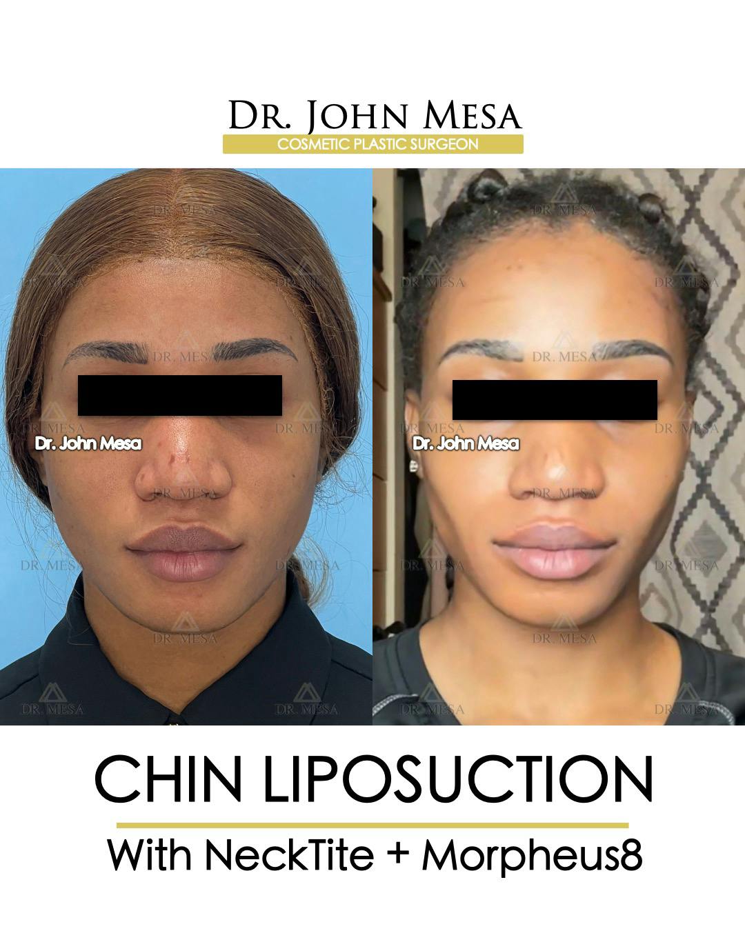 Chin Liposuction Before & After Gallery - Patient 148735140 - Image 1