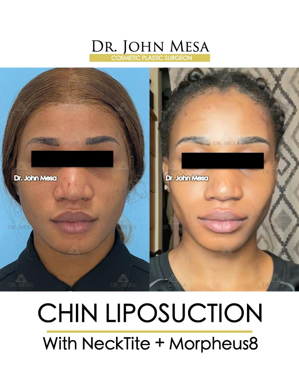 Chin Liposuction Before & After Gallery - Patient 148735140 - Image 1