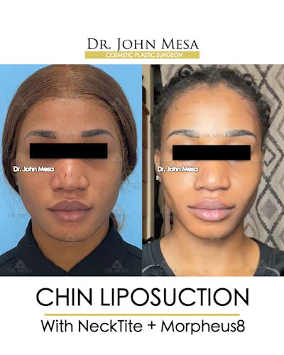 Chin Liposuction Before & After Gallery - Patient 148735140 - Image 2