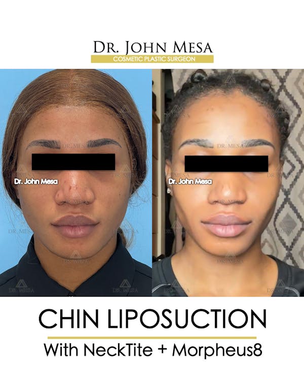 Chin Liposuction Before & After Gallery - Patient 148735140 - Image 1