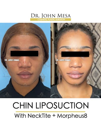 Chin Liposuction Before & After Gallery - Patient 148735140 - Image 1