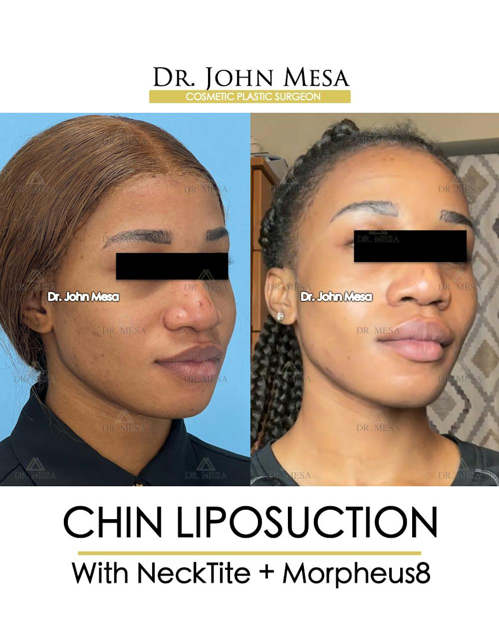 Chin Liposuction Before & After Gallery - Patient 148735140 - Image 3