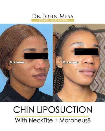 Chin Liposuction Before & After Gallery - Patient 148735140 - Image 2