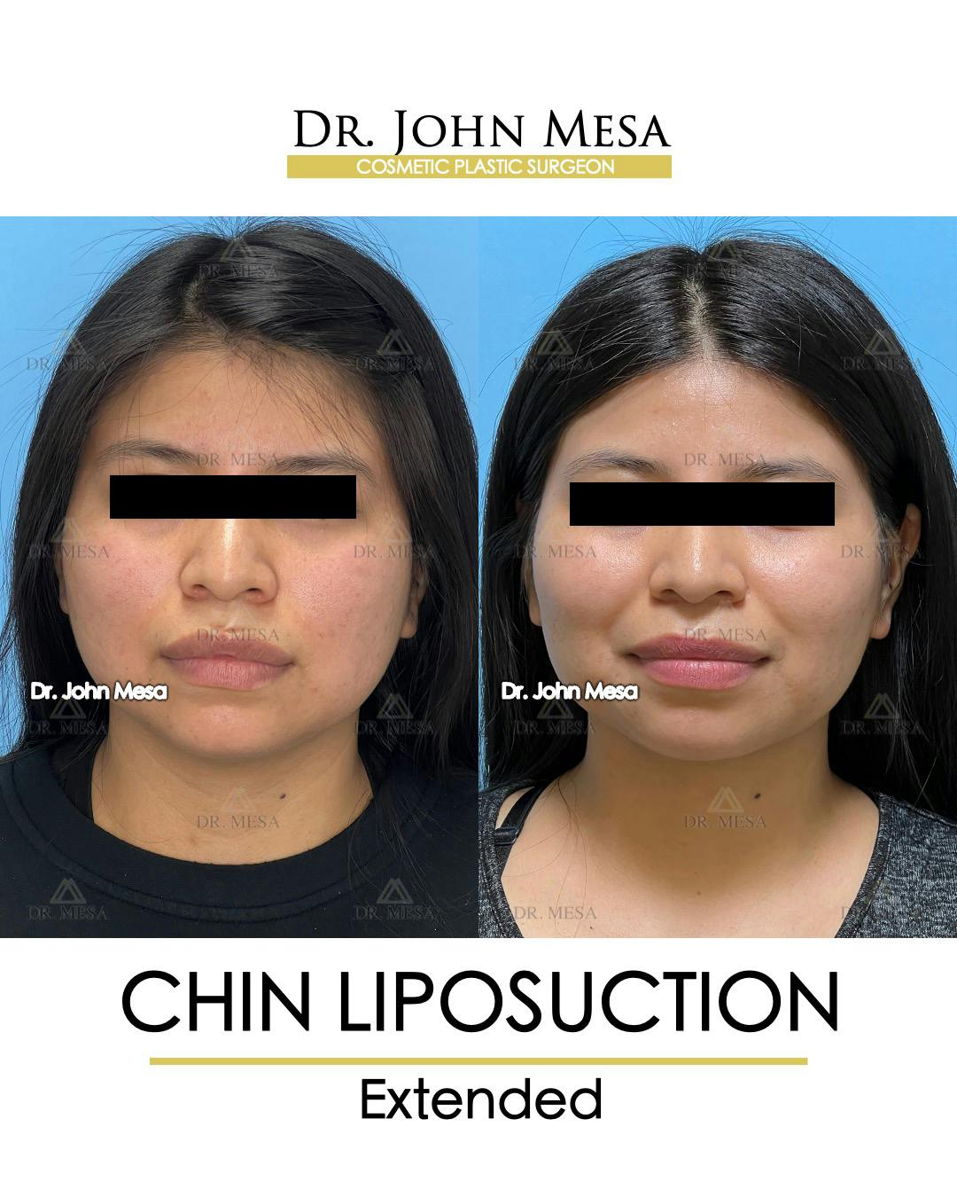 Chin Liposuction Before & After Gallery - Patient 148735141 - Image 1