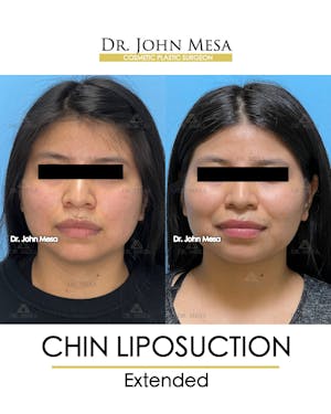 Do You Need to Wear a Compression Garment After Chin Liposuction
