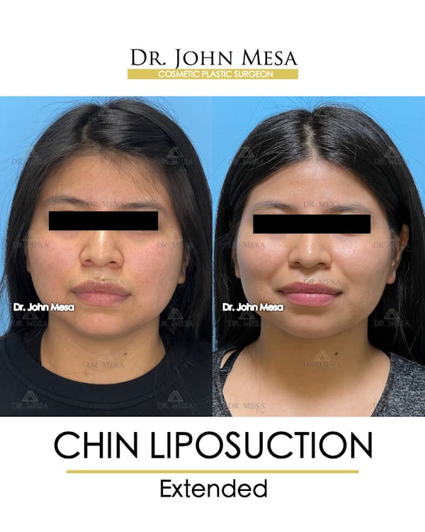 Chin Liposuction Before & After Gallery - Patient 148735141 - Image 1