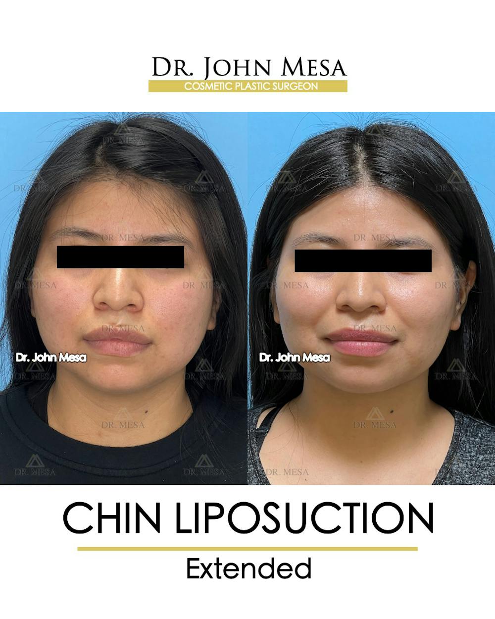 Chin Liposuction Before & After Gallery - Patient 148735141 - Image 2