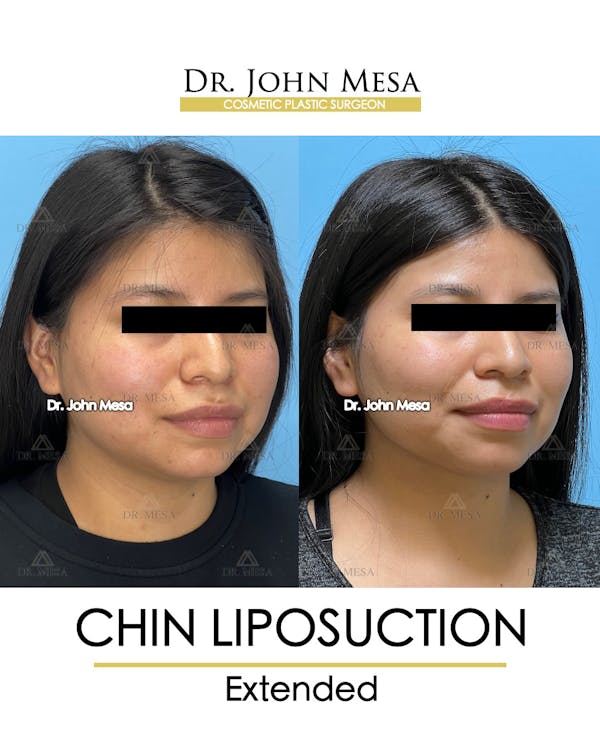 Chin Liposuction Before & After Gallery - Patient 148735141 - Image 2