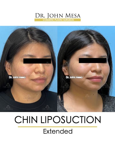 Chin Liposuction Before & After Gallery - Patient 148735141 - Image 2