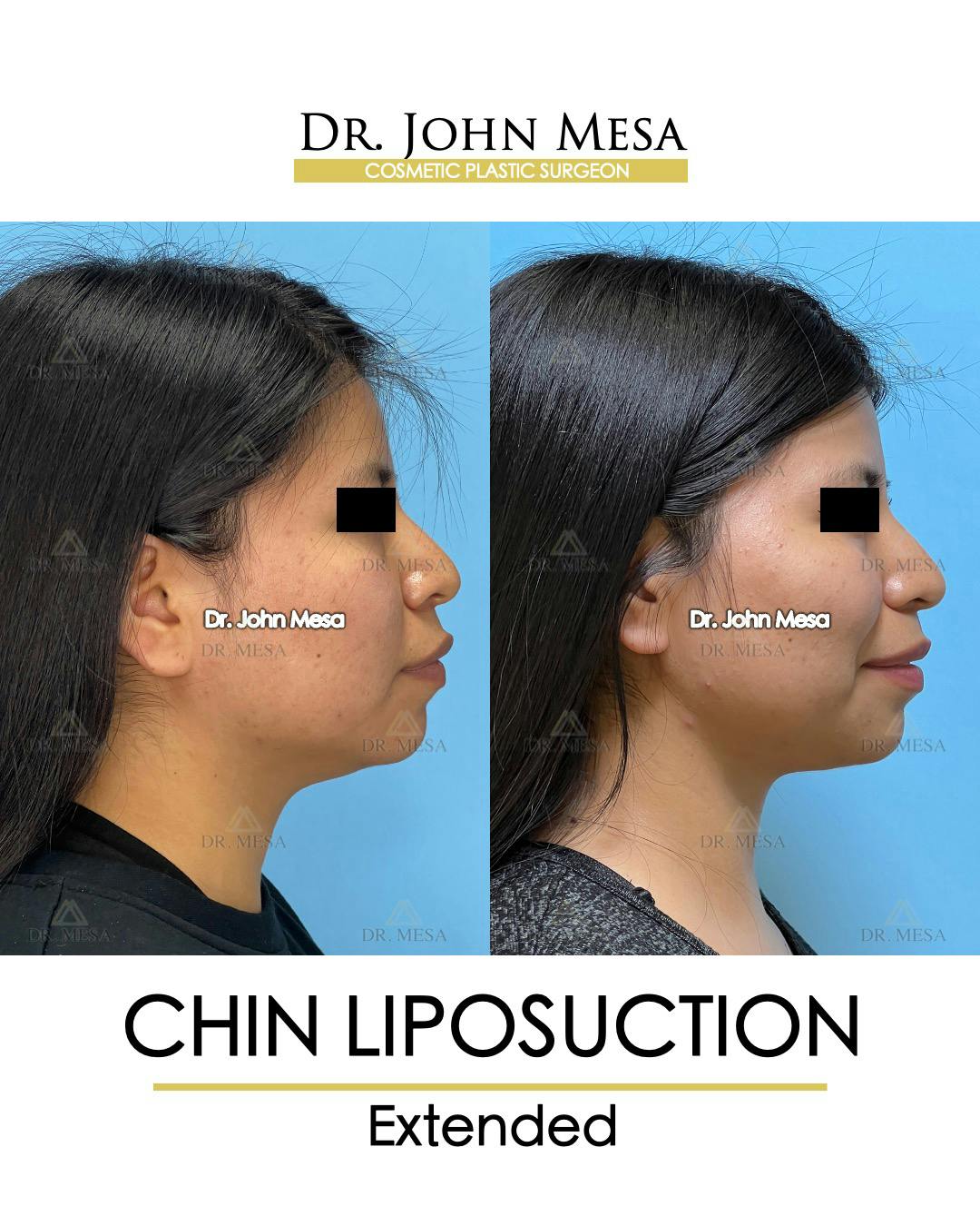Chin Liposuction Before & After Gallery - Patient 148735141 - Image 1