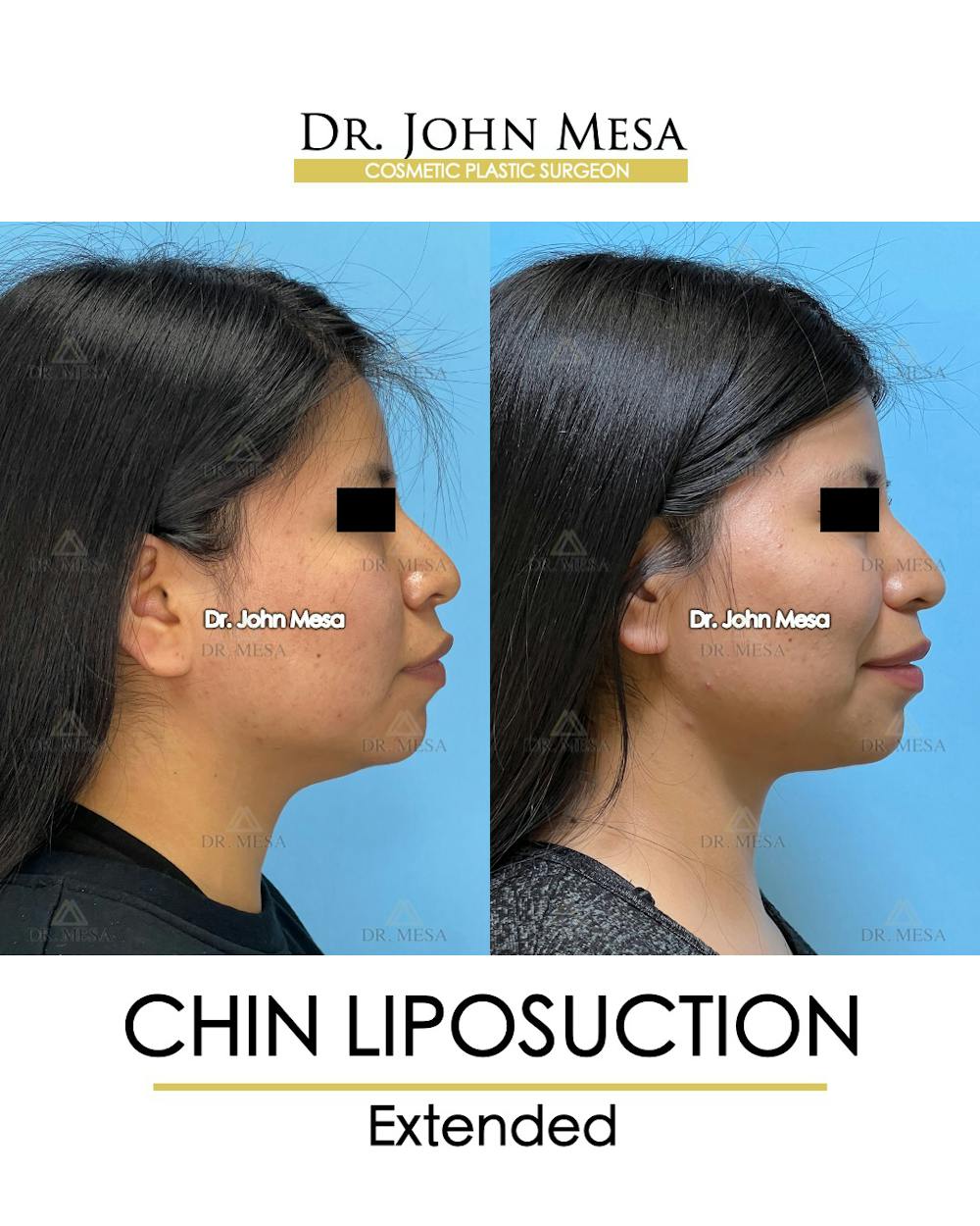 Chin Liposuction Before & After Gallery - Patient 148735141 - Image 3
