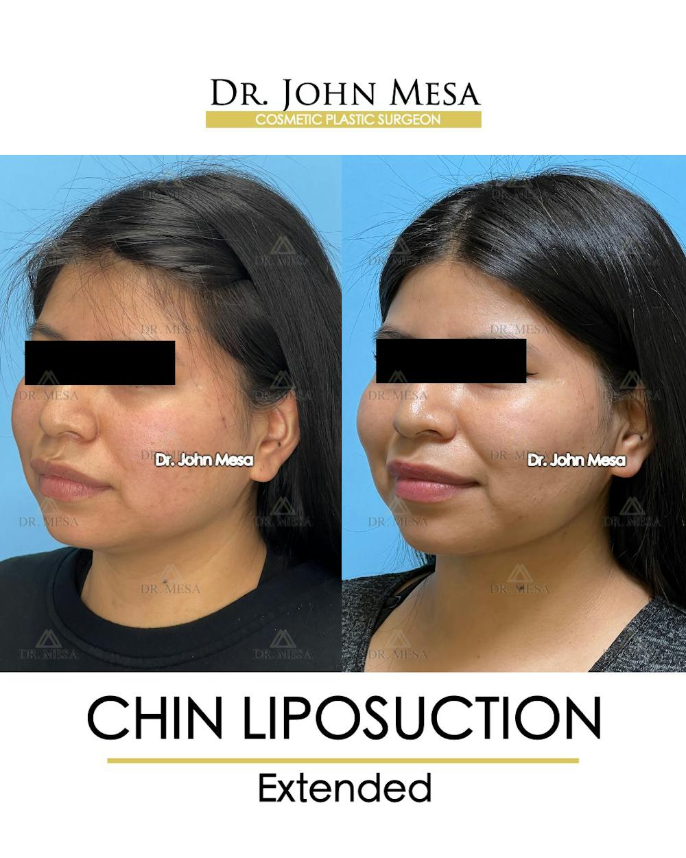 Chin Liposuction Before & After Gallery - Patient 148735141 - Image 4