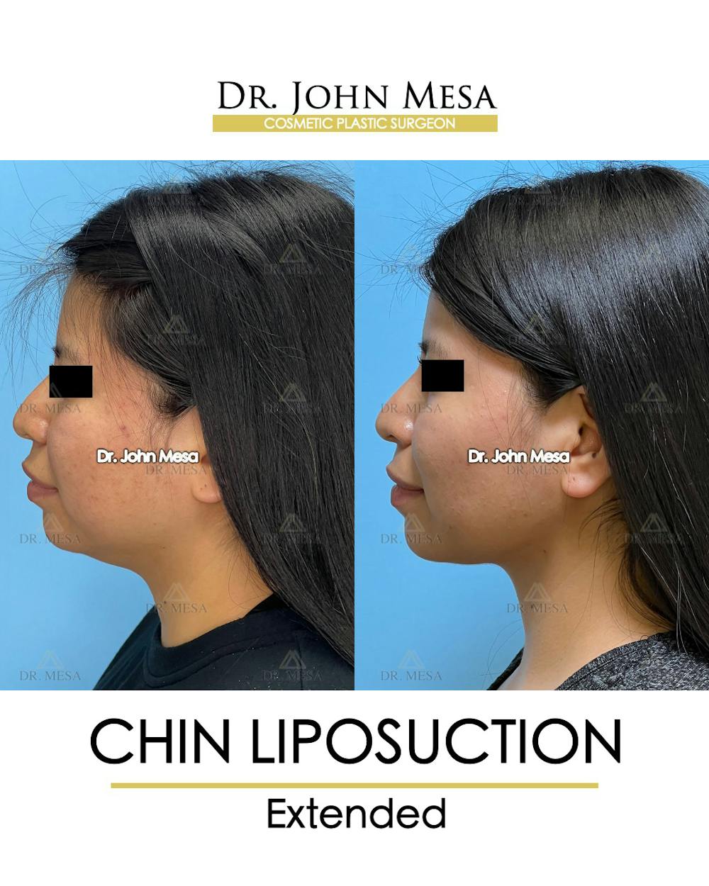 Chin Liposuction Before & After Gallery - Patient 148735141 - Image 5