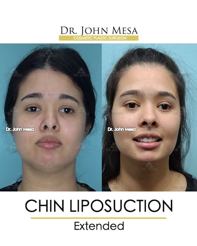 Chin Liposuction Before & After Gallery - Patient 148735143 - Image 2