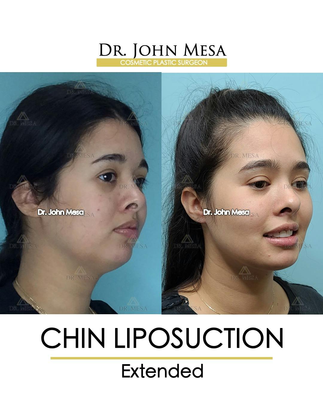 Chin Liposuction Before & After Gallery - Patient 148735143 - Image 2