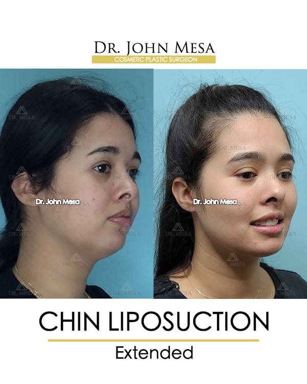 Chin Liposuction Before & After Gallery - Patient 148735143 - Image 2