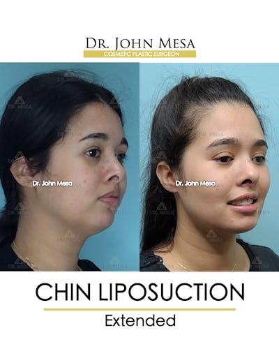Chin Liposuction Before & After Gallery - Patient 148735143 - Image 2