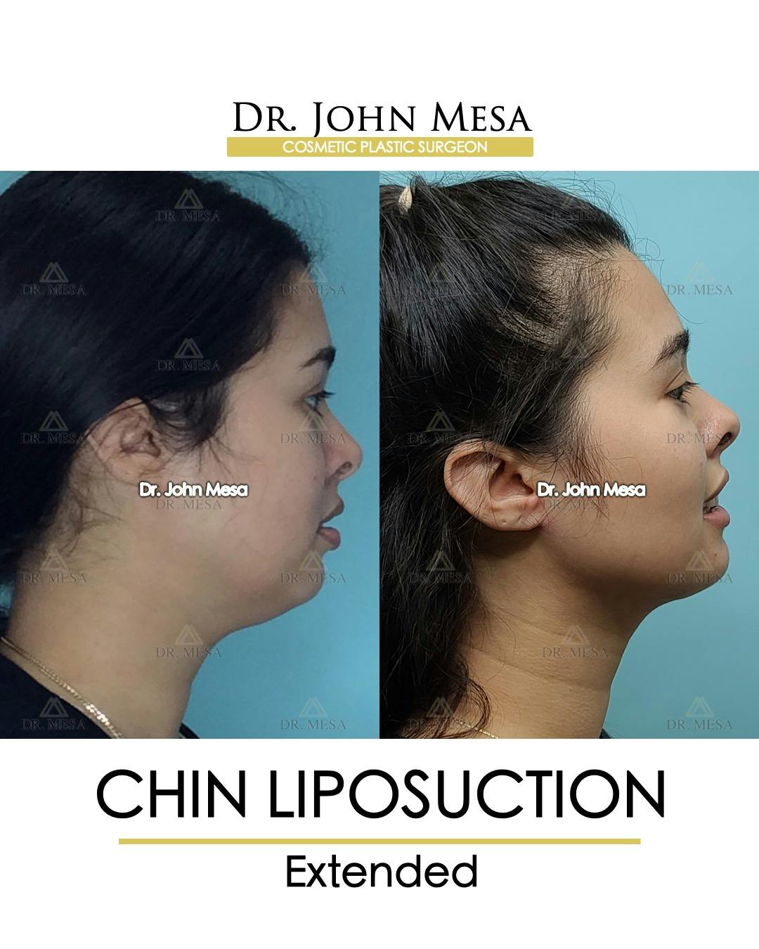 Chin Liposuction Before & After Gallery - Patient 148735143 - Image 1