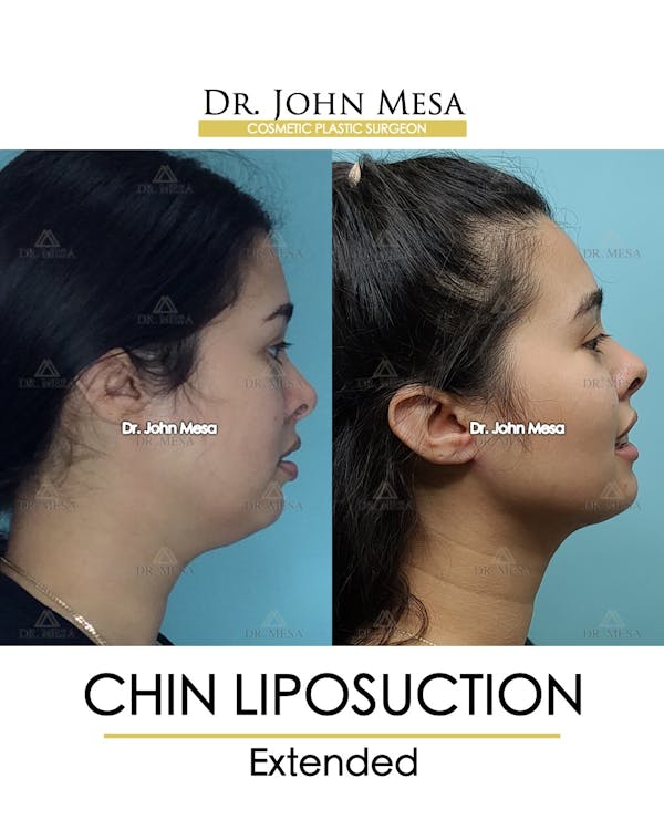 Chin Liposuction Before & After Gallery - Patient 148735143 - Image 3